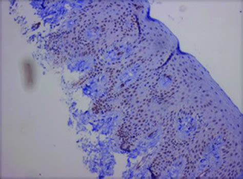 Immunohistochemical expression of α SMA positive MFs in normal mucosa