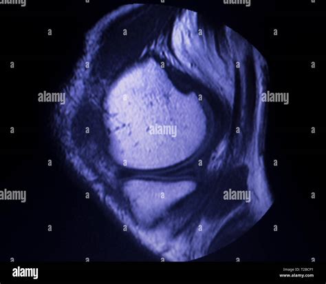 Imágenes Por Resonancia Magnética Irm De La Rodilla Cuerno Posterior