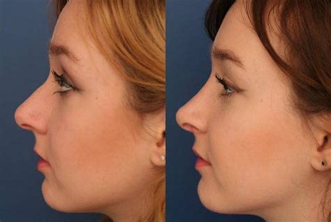 Hooked Nose Operation Photo Before And After Rhinoplasty Cost Pics