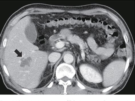 Figure 1 From Liver Abscess Caused By Edwardsiella Tarda A Case Report