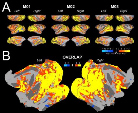 A Statistical Parametric Maps For The Contrast Vision EC EI Versus