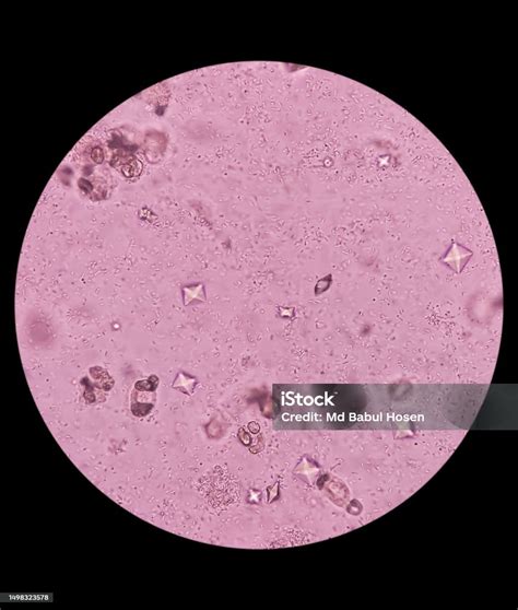 Uti Budding Yeast Cells And Calcium Oxalate Crystal In Urine Urinary ...