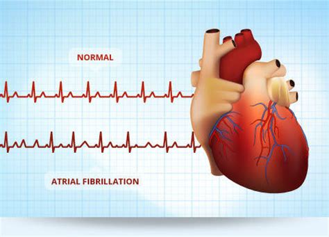 Atrial Fibrillation & Heart Valve Patient Education Center