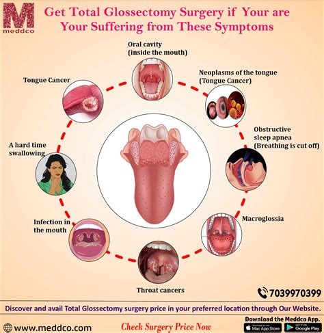 Total Glossectomy Surgery : Free Download, Borrow, and Streaming ...