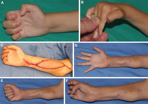 Refinements In The Treatment Of Volkmann Ischemic Contracture Of The