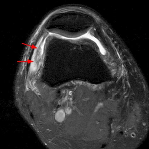 Synovial Plicae Of The Knee Radsource