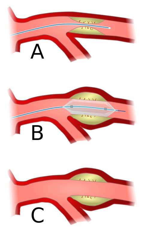 Peripheral Artery Disease Treatment ECCO Endovascular Consultants