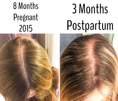 Women And Hair Loss Causes Solutions And Support — First Thyme Mom