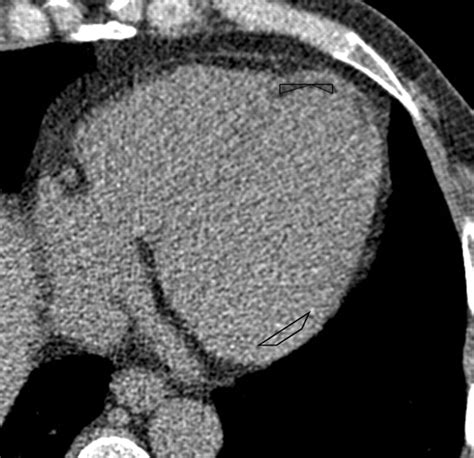 Ct Detection Of Subendocardial Fat In Myocardial Infarction Ajr