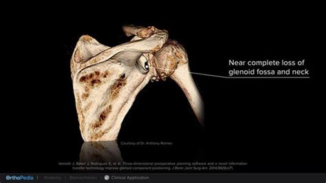 Focus On Glenohumeral Osteoarthritis And Treatment Orthopedia Academics