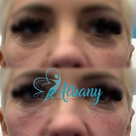 Tear Trough Fillers Albany Cosmetic And Laser Centre