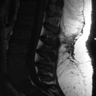 Resonancia magnética corte sagital donde se demuestra la presencia de