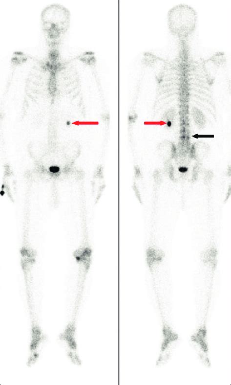 Whole Body Bone Scan With Tc Mdp Of The Patient A Anterior And B