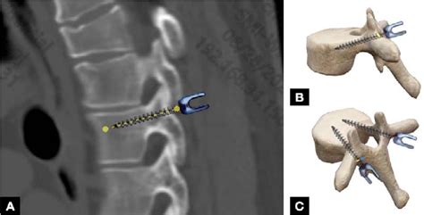 Pdf Accuracy And Outcomes Of Freehand Thoracic Pedicle Screw