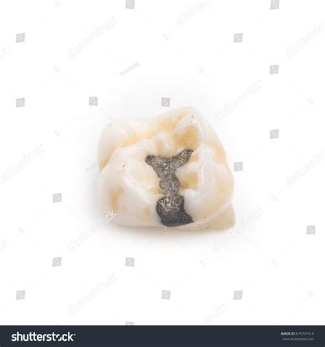 Filling Primary Tooth Molar Tooth Stock Photo 675737416 | Shutterstock