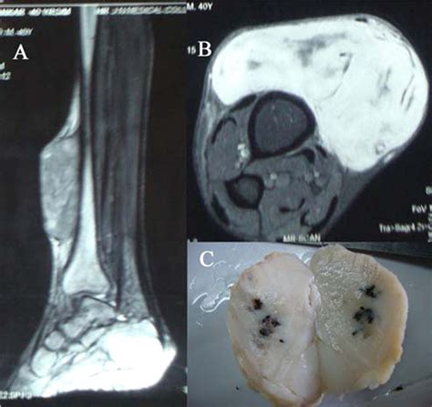 Solitary Fibrous Tumour Of The Lower Leg An Uncommon Site With