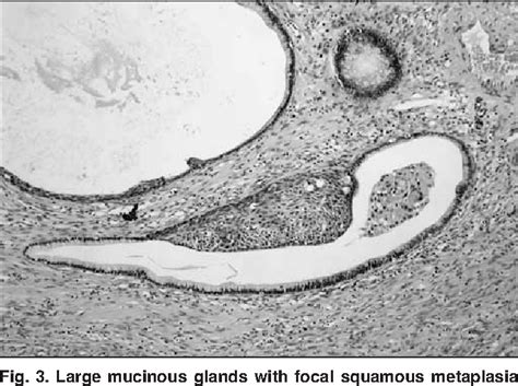 Figure 3 From Tubulo Squamous Polyp Of The Vagina Semantic Scholar