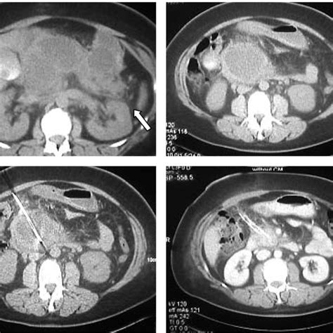 [PDF] Surgery in the Treatment of Acute Pancreatitis Minimal Access ...