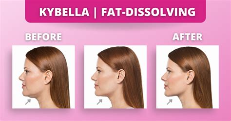 Kybella Fat Dissolving Injections Our In Depth Review The Botox Lady