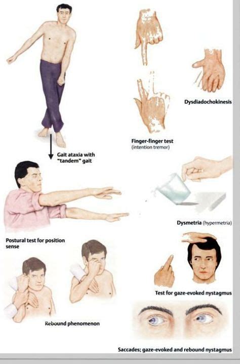 Cerebellar Signs Gait Ataxia Tandem Gait Dysdiadochokinesis