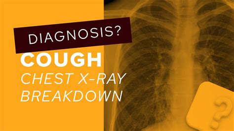 Chest X Ray Breakdown A Guide To Bronchiectasis On Imaging Youtube