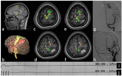 Mri Paracentral Lobule