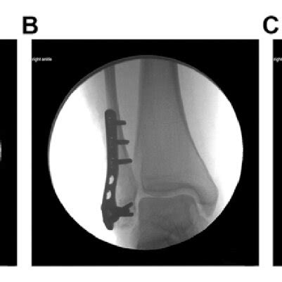 Intraoperative Fluoroscopic Images Showing A The Distal Fragment