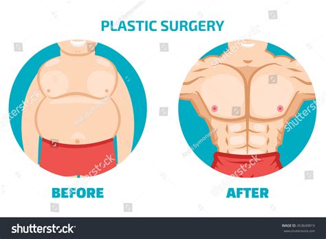 Plastic Surgery Man Before After Stock Vector (Royalty Free) 453649819 ...