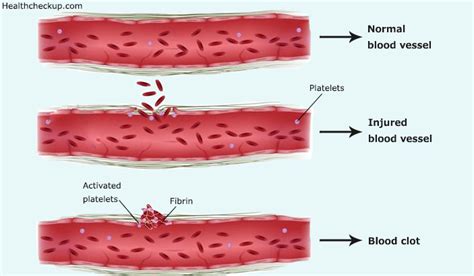 Blood Clots When Pregnant Causes Signs Treatment By Dr Himanshi