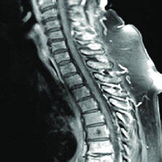 C-spine MRI showing T8 fracture and discitis 1 week later | Download ...