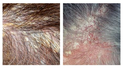 Cradle Cap In Adults Seborrhoea Everything You Need To