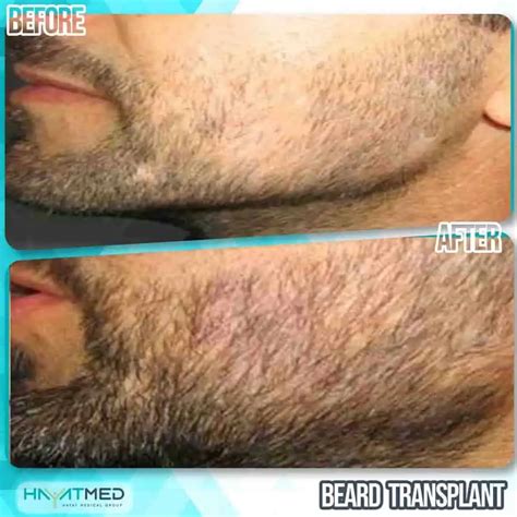 Beard Transplant In Turkey: Is It Safe And Price For 2023