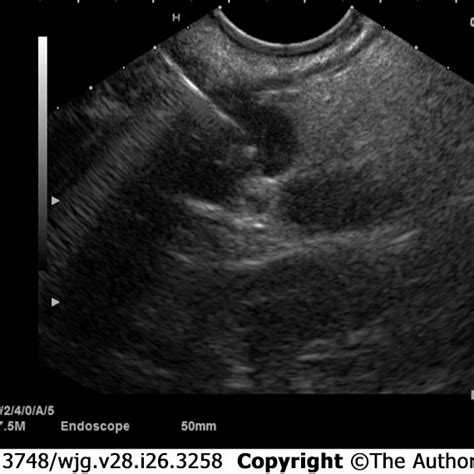 Endoscopic Appearance At Endoscopic Ultrasound Of A Pancreatic Download Scientific Diagram