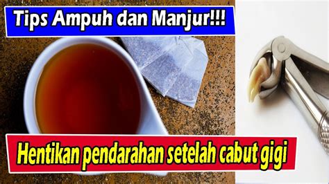 CARA MENGHENTIKAN DARAH SETELAH CABUT GIGI DENGAN TEH KANTONG YouTube