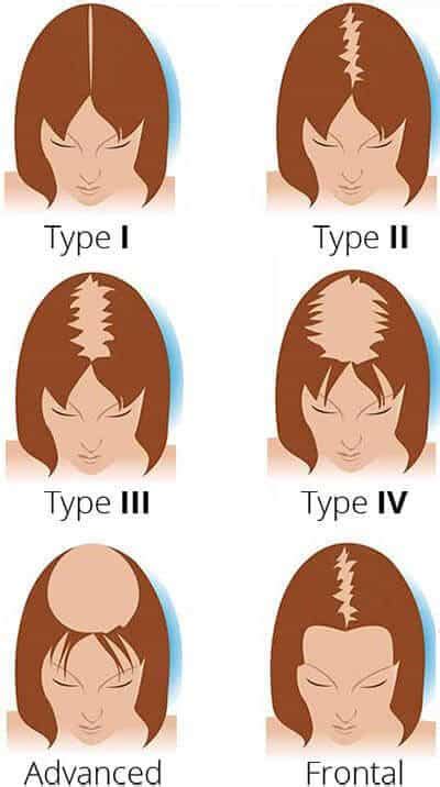 The Ludwig Scale For Womens Hair Loss Hair Restoration Center