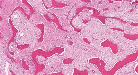 Osteoma | Atlas of Pathology