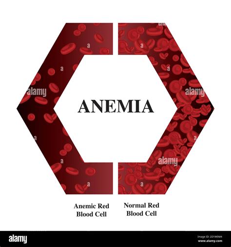 Anemia Amount Of Red Blood Iron Deficiency Anemia Difference Of Anemia