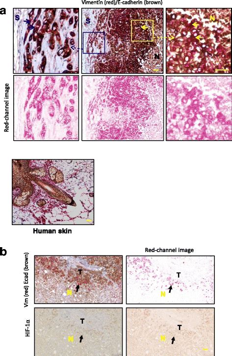 A Epithelial To Mesenchymal Transition Emt In Mda Mb Xenograft