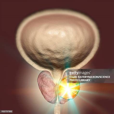 Prostate Cancer Anatomy Photos And Premium High Res Pictures Getty Images