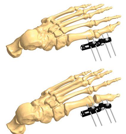 Foot Fracture Treatment Orthofix ABS