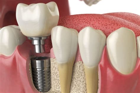 Qué debes saber sobre las complicaciones de los implantes dentales