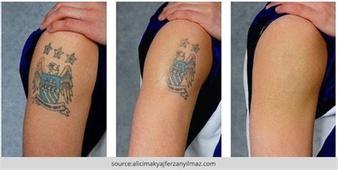 How To Remove A Permanent Tattoo: DIY Methods and Surgical Methods