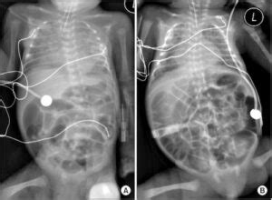 Meconium Ileus - The Operative Review Of Surgery