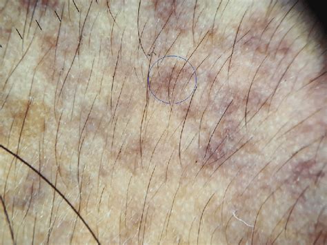 Dermoscopy Of Nevus Of Ota Shows Gray Blue Structureless Area Blue