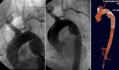 Technique For Subclavian To Carotid Transposition Tips And Tricks Journal Of Vascular Surgery