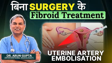 Uterine Fibroid Non Surgical Treatment Using Uterine Artery