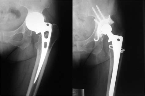 Austinemoore Prosthesis Protrusio With Acetabular American Academy Of