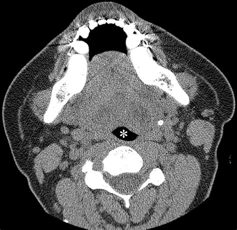 Radiology Of Cleft Lip And Palate Imaging For The Prenatal Period And