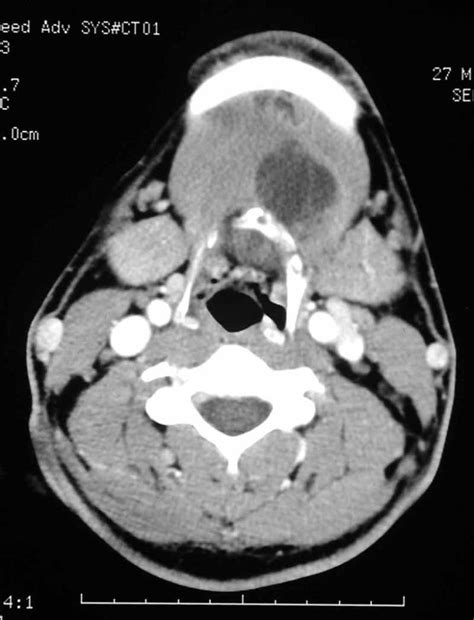 Thyroglossal Duct Cysts Dermatology Advisor