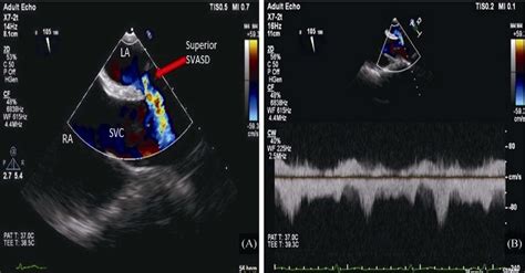 Sinus venosus atrial septal defect. (A): Transthoracic echocardiogram ...